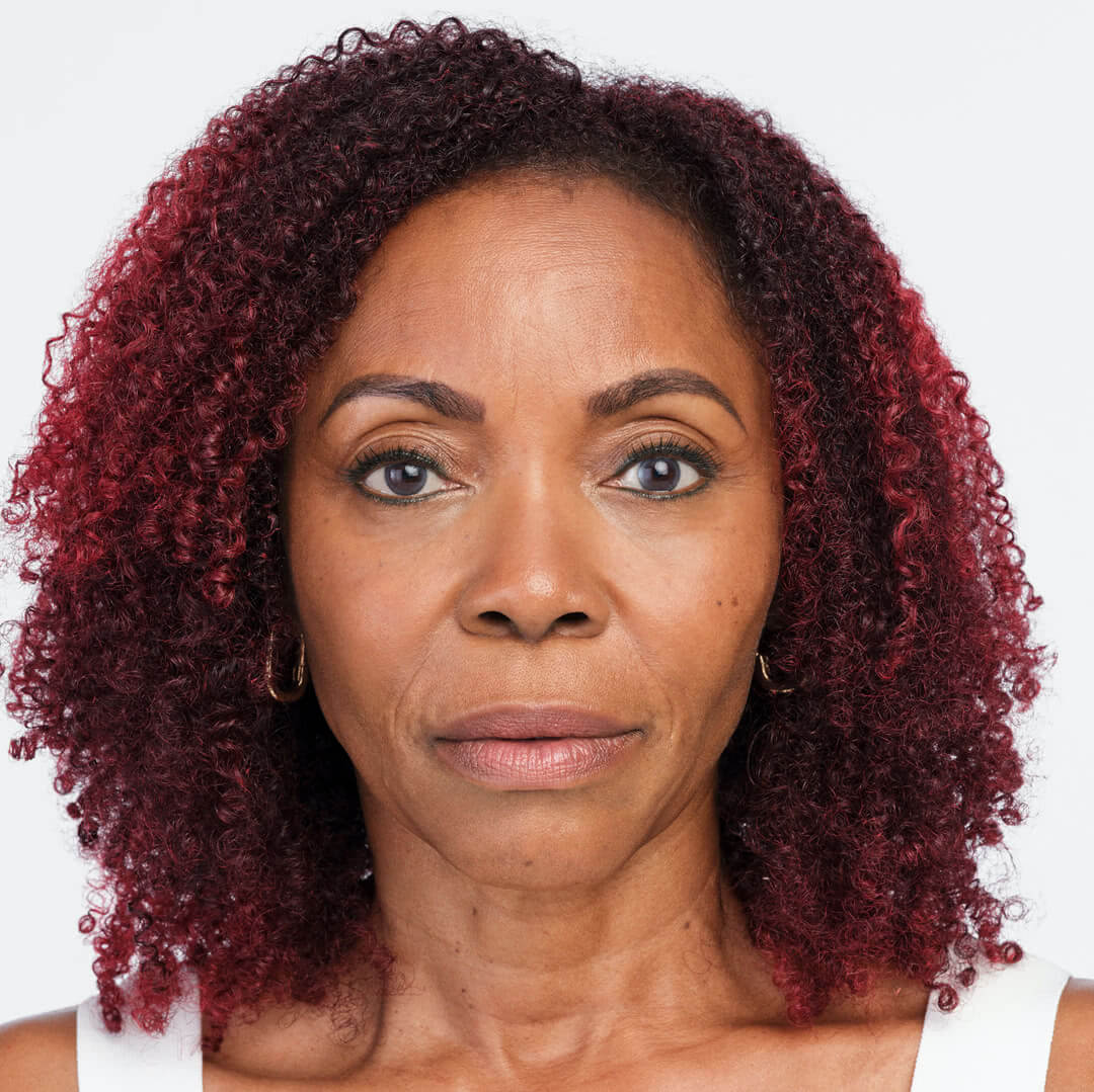 Debra front view after 4 weeks of Radiesse & Belotero treatment