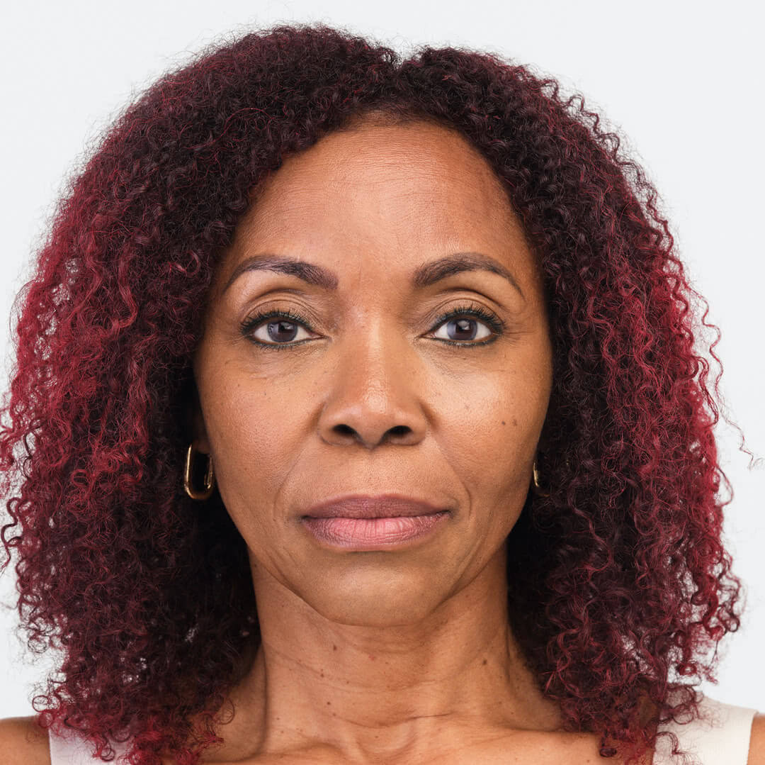 Debra front view after 6 months of Radiesse & Belotero treatment