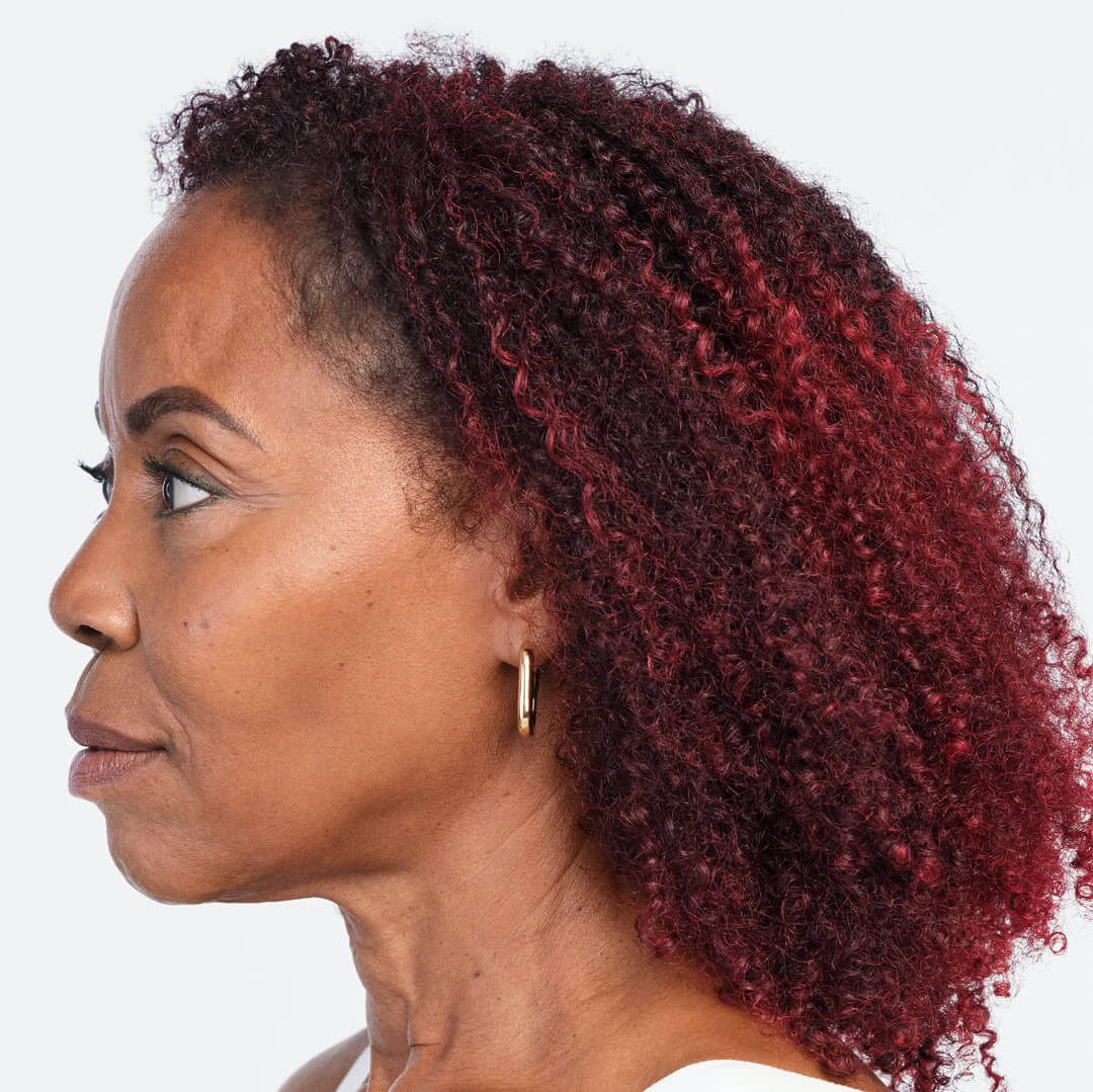 Debra profile view after 4 weeks of Radiesse & Belotero treatment