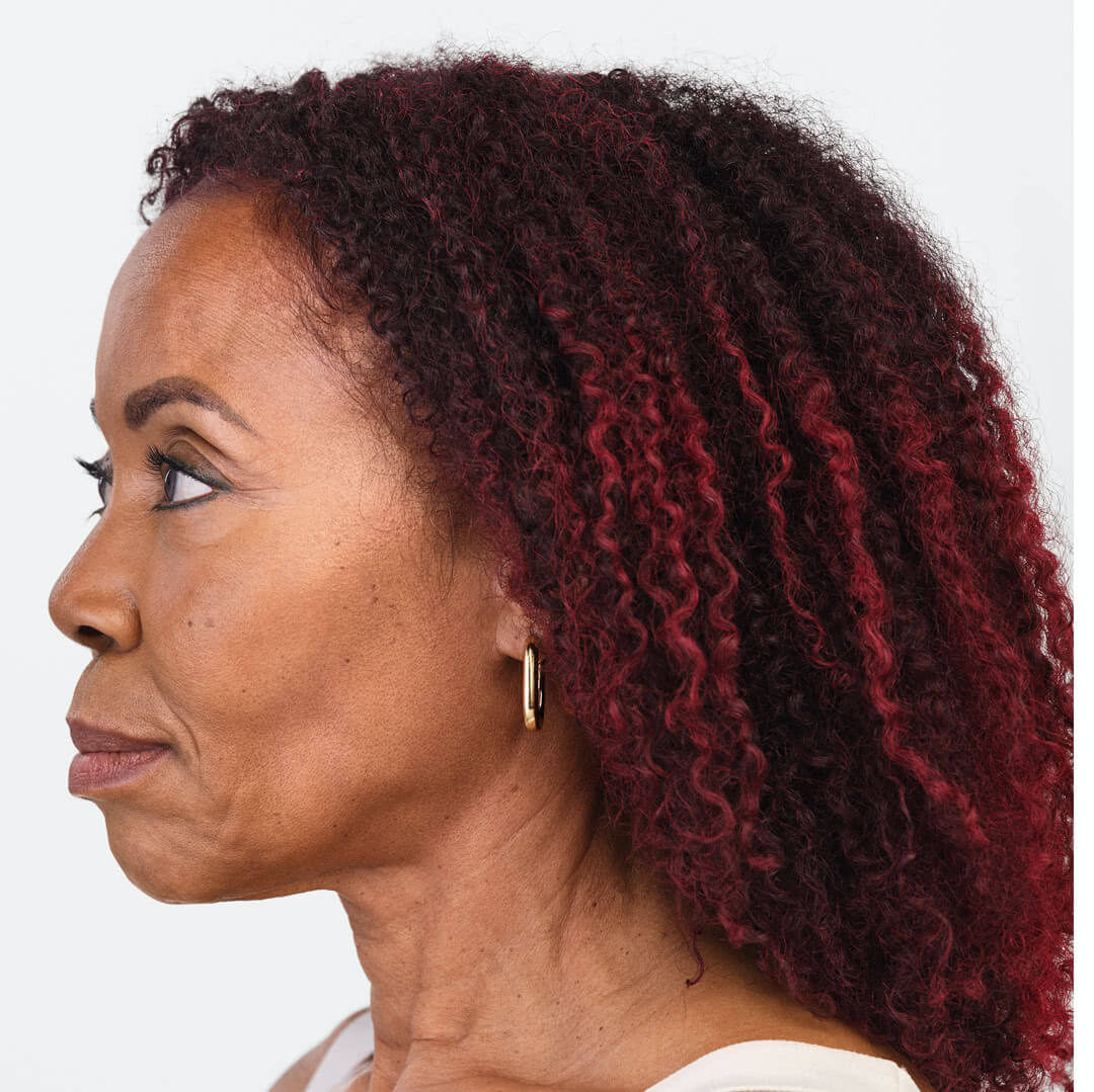 Debra profile view after 6 months of Radiesse & Belotero treatment