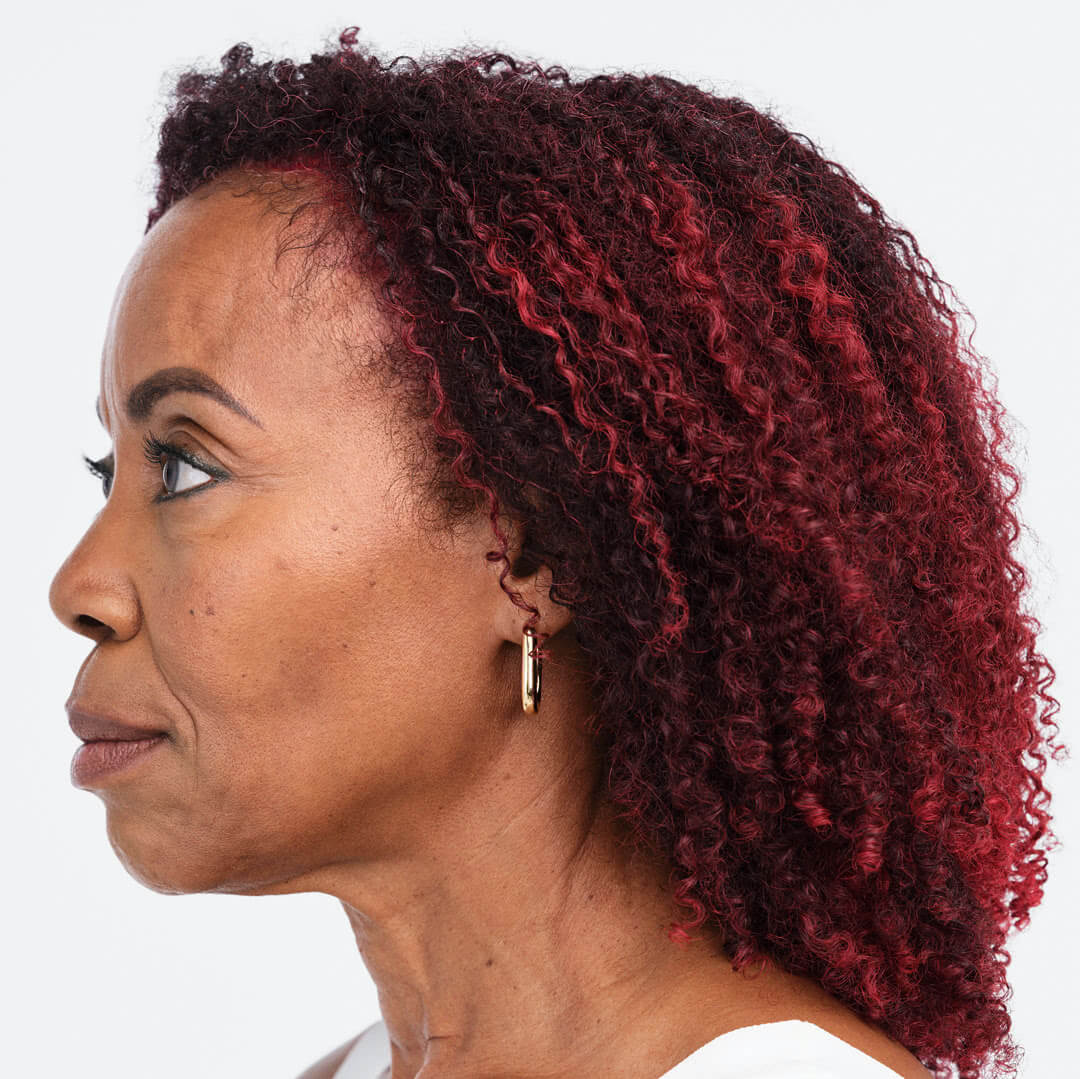 Debra profile view before treatment