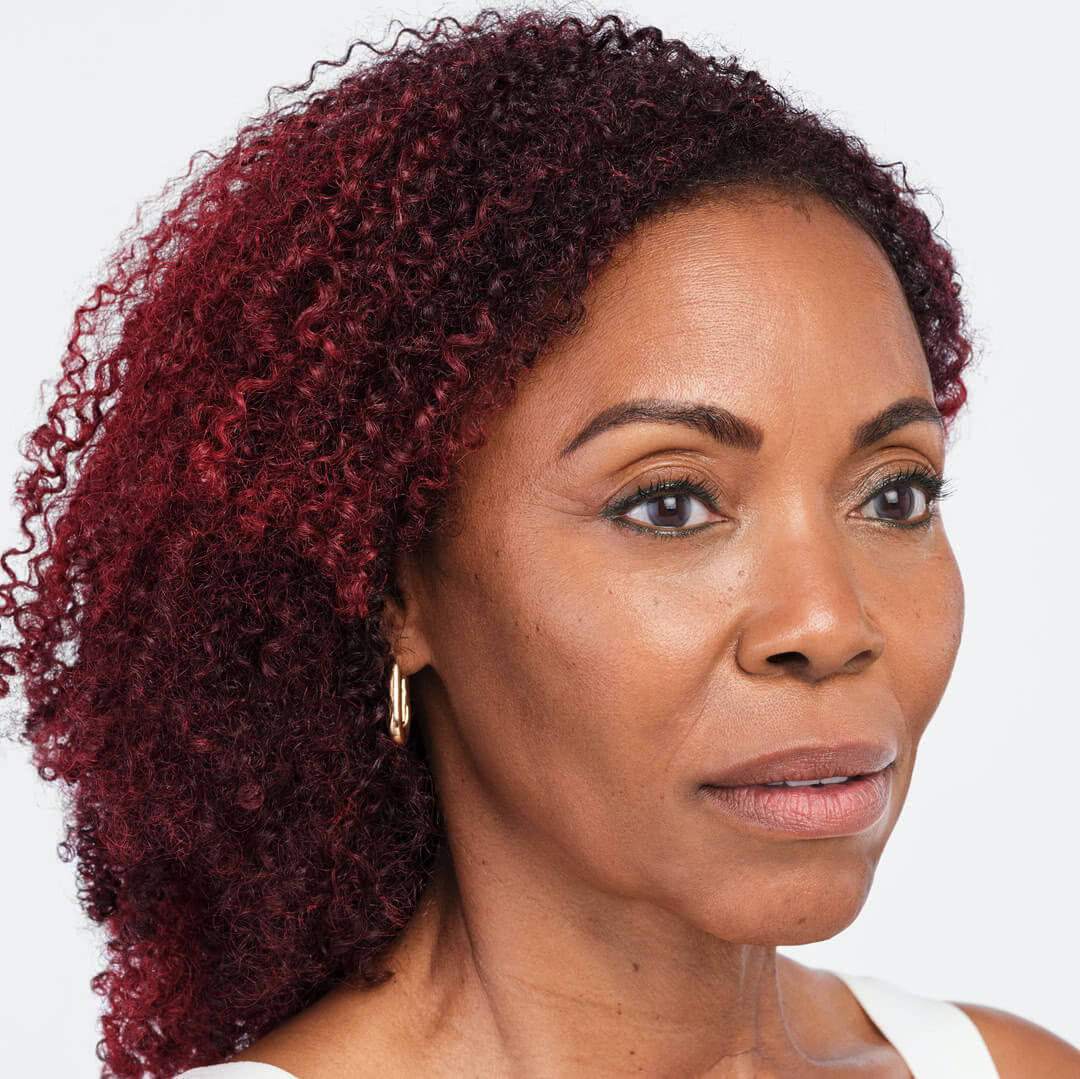 Debra three-quarter view after 4 weeks of Radiesse & Belotero treatment