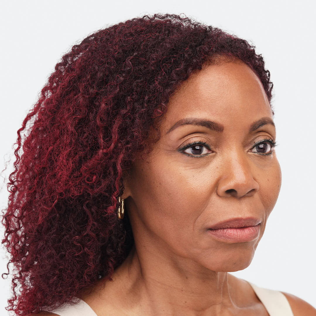 Debra three-quarter view after 6 months of Radiesse & Belotero treatment