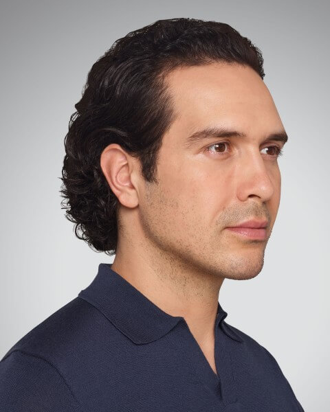 Devin treatment after – Juvederm Dermal Fillers