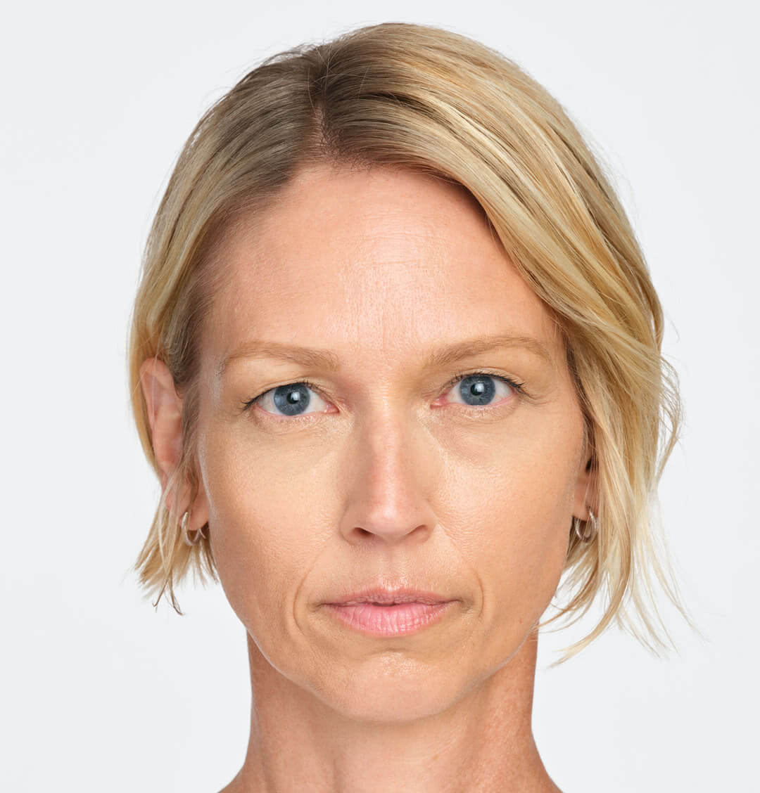 Jackie front view after 4 weeks of Radiesse treatment