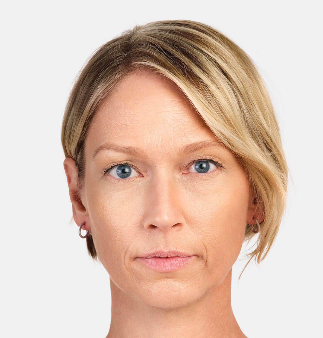 Jackie front view after 6 months of Radiesse treatment