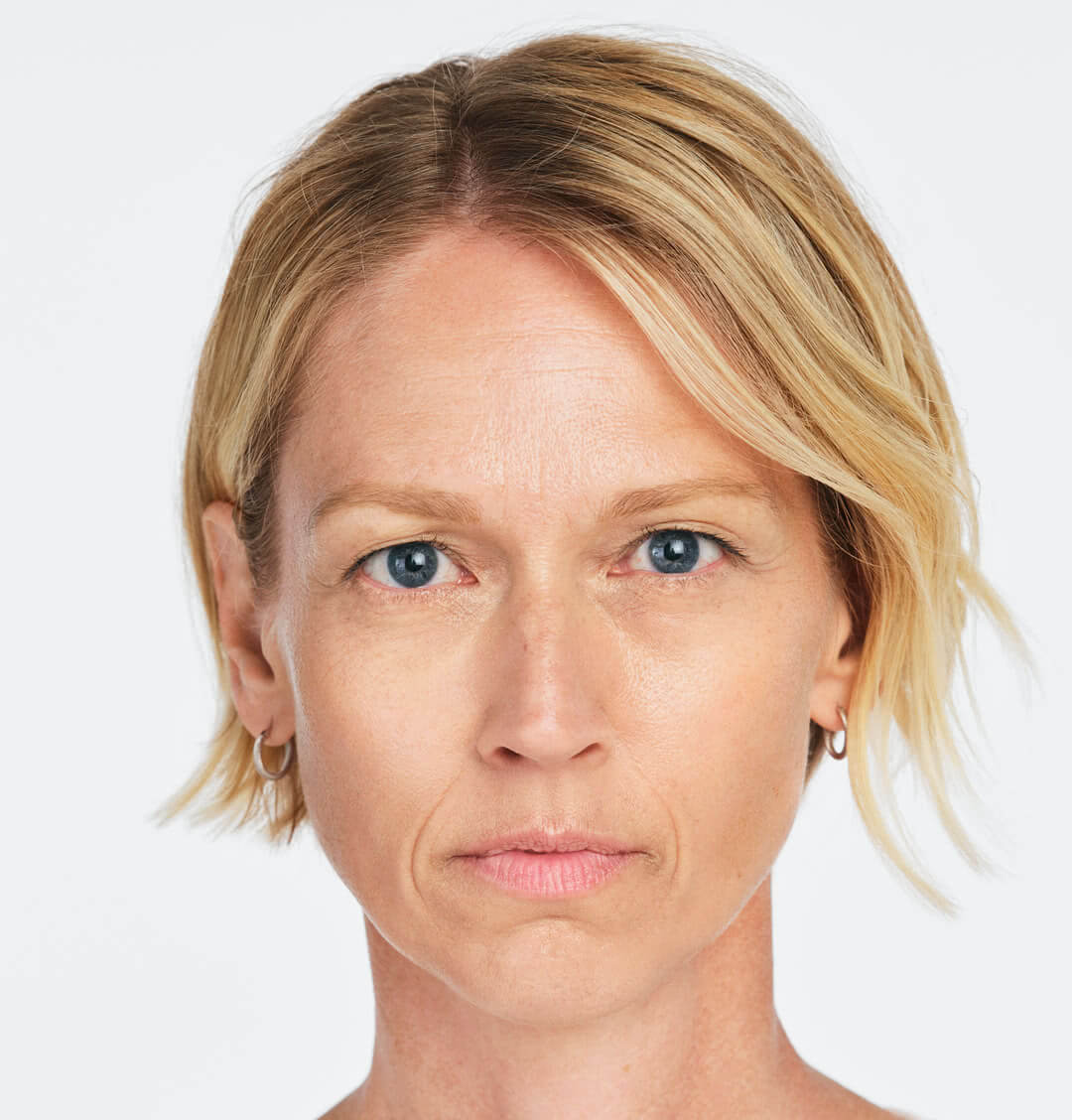 Jackie front view before treatment