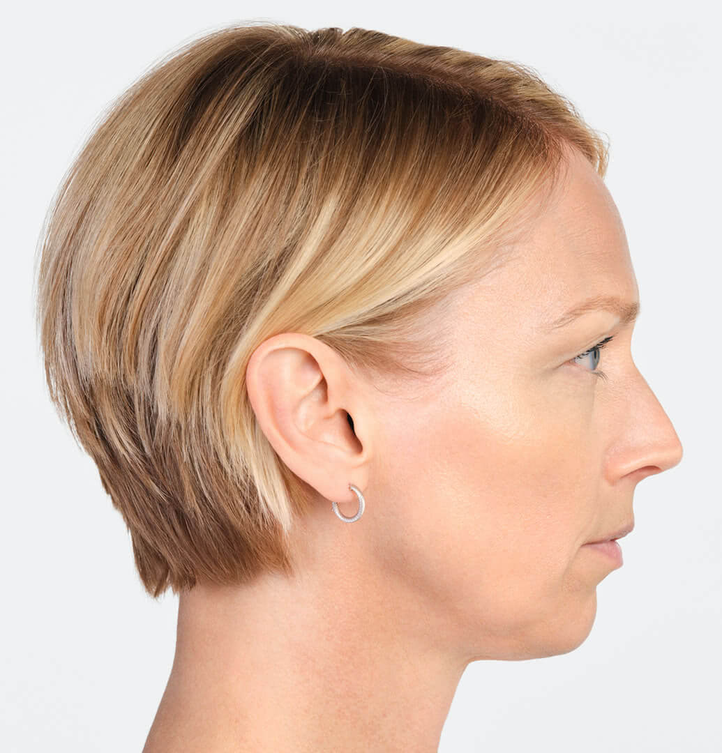 Jackie profile view after 6 months of Radiesse treatment