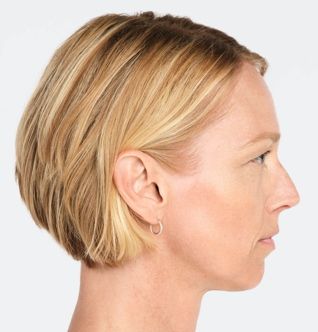 Jackie profile view before treatment