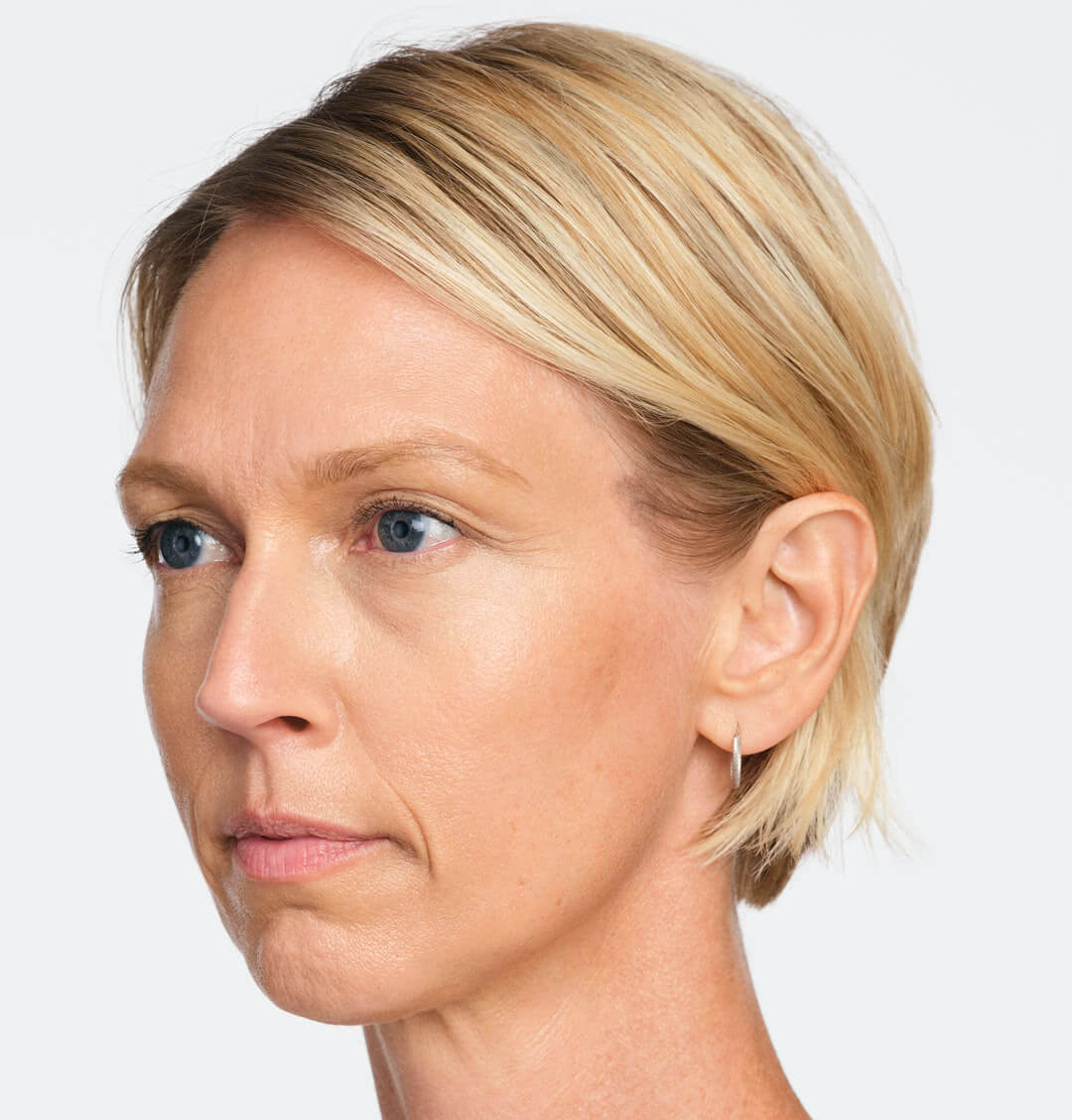 Jackie three-quarter view after 4 weeks of Radiesse treatment