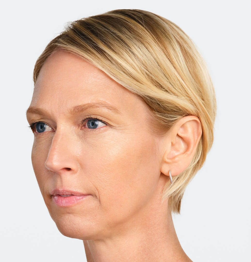 Jackie three-quarter view after 6 months of Radiesse treatment