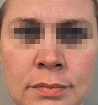 Profhilo treatment Malar Submental after