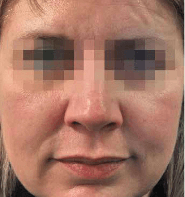 Profhilo treatment Malar Submental before