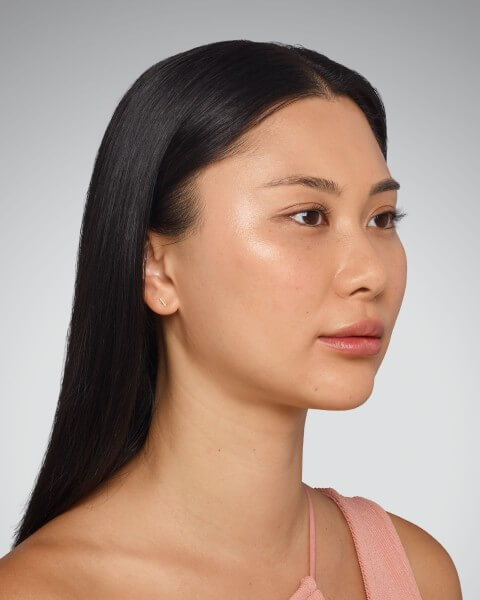 Sara treatment after – Juvederm Dermal Fillers