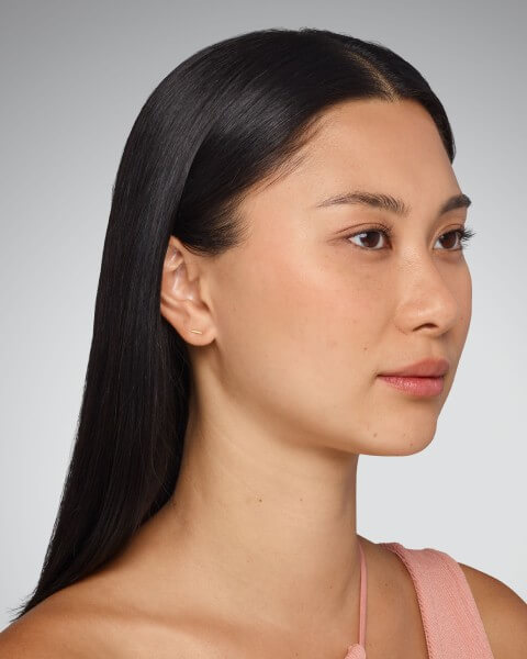 Sara treatment before – Juvederm Dermal Fillers