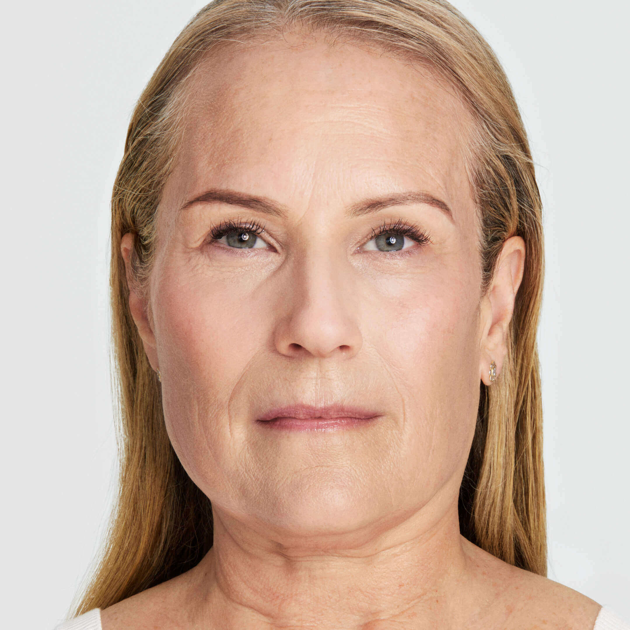 Debbie after 180 days of Ultherapy Prime