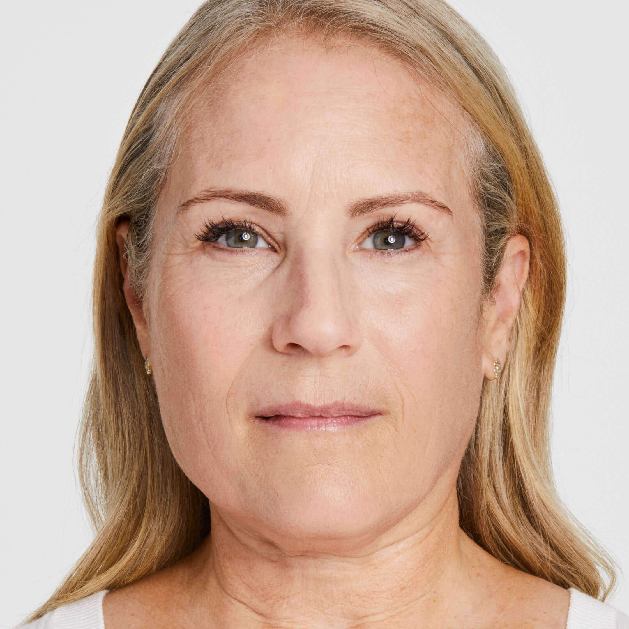 Debbie after 60 days of Ultherapy Prime