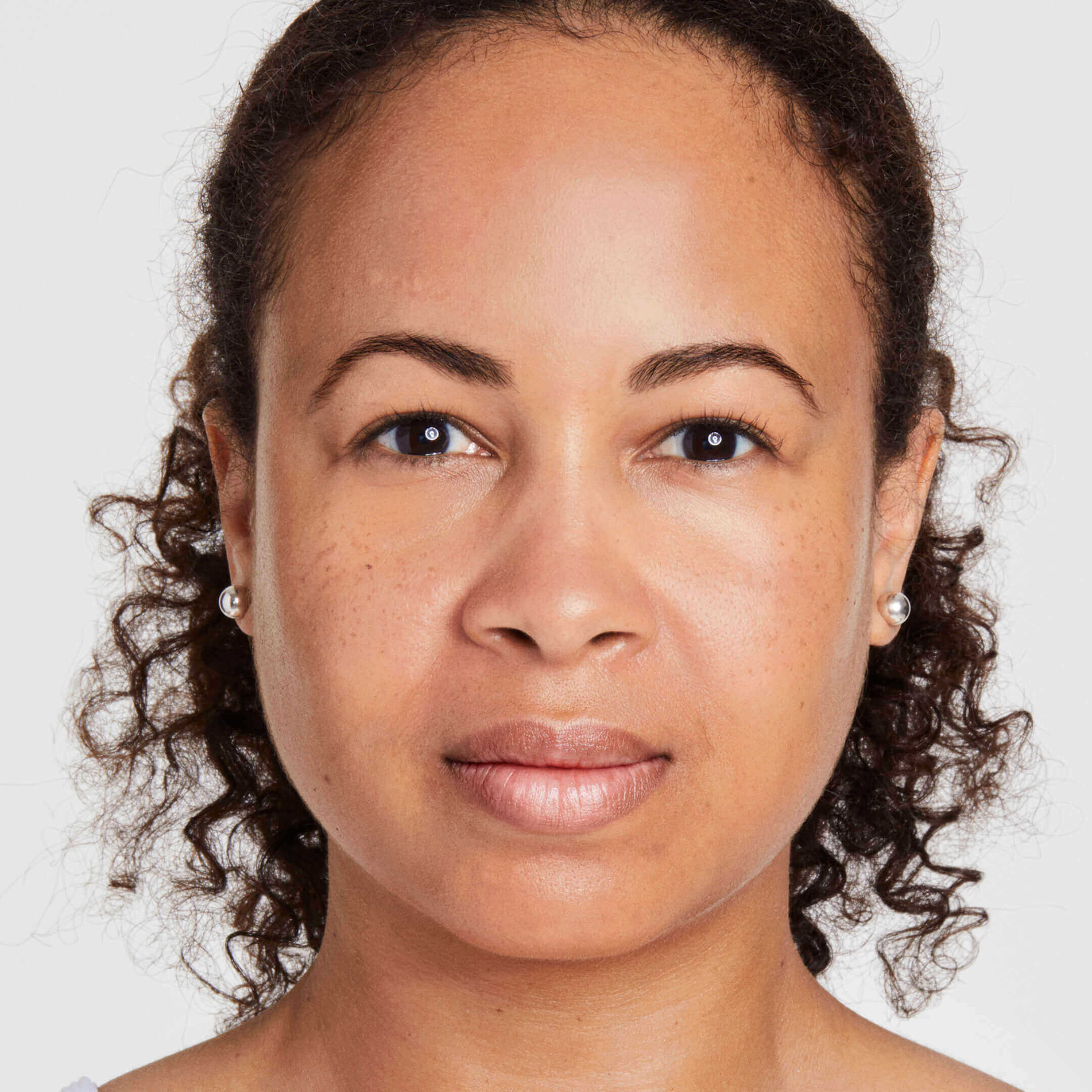 Erin after 60 days of Ultherapy Prime
