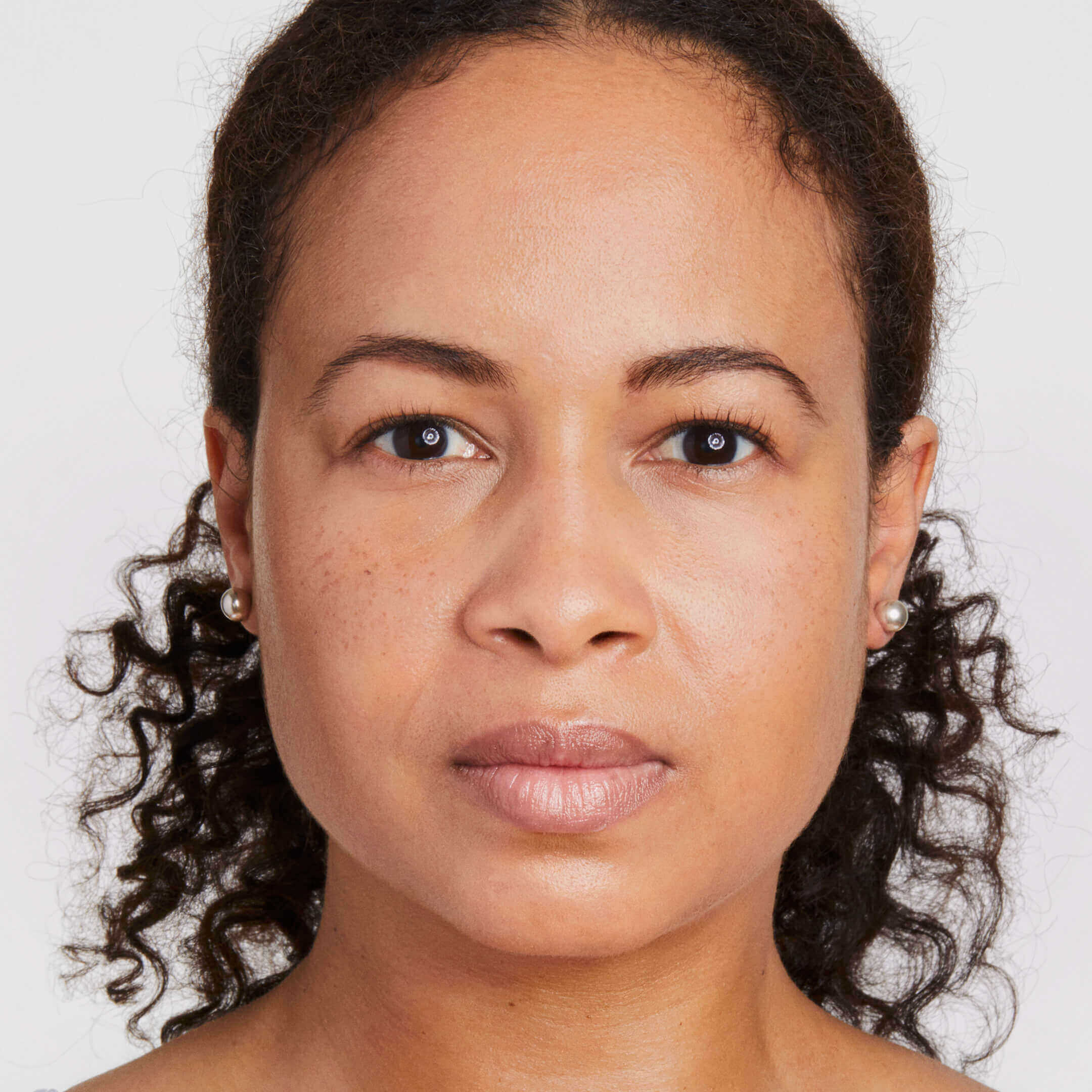 Erin before Ultherapy Prime