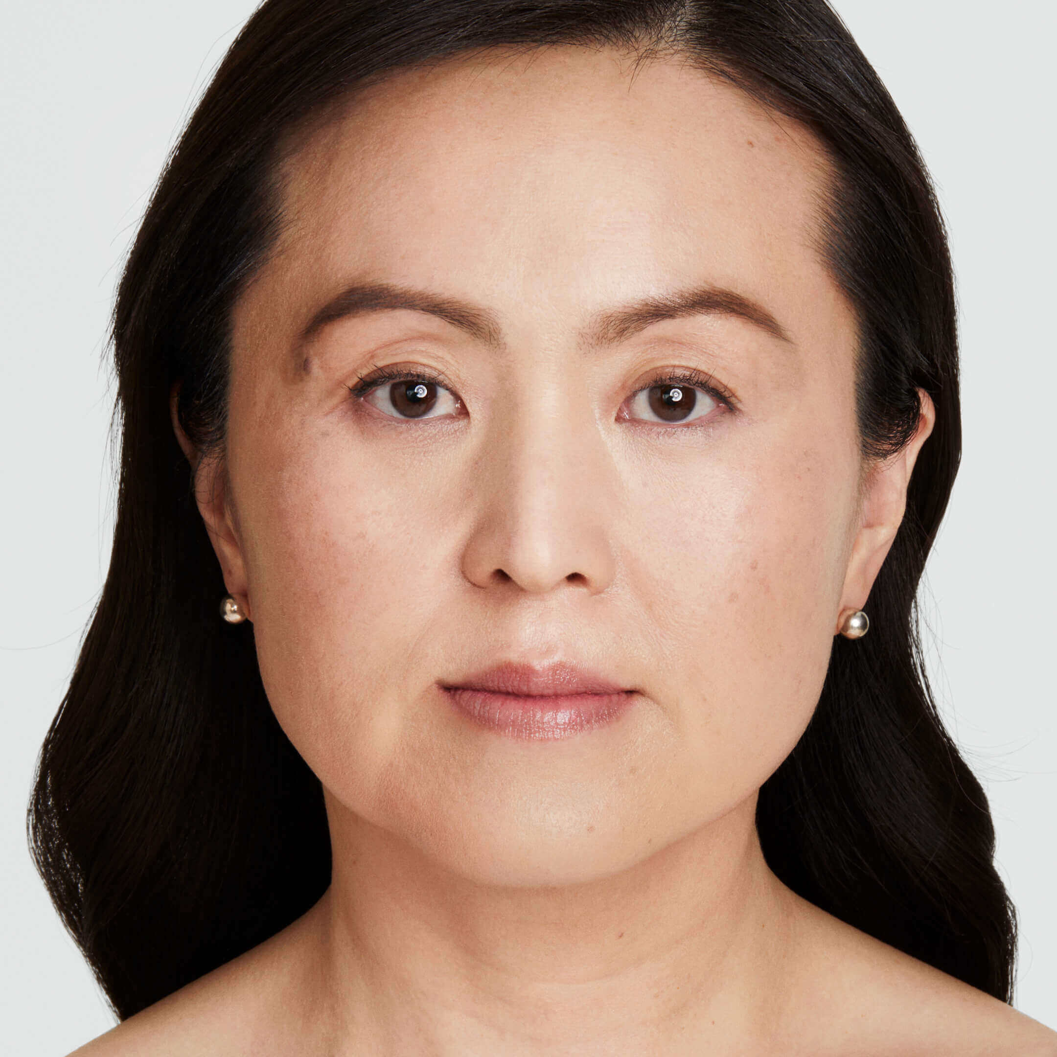 Grace after 180 days of Ultherapy Prime