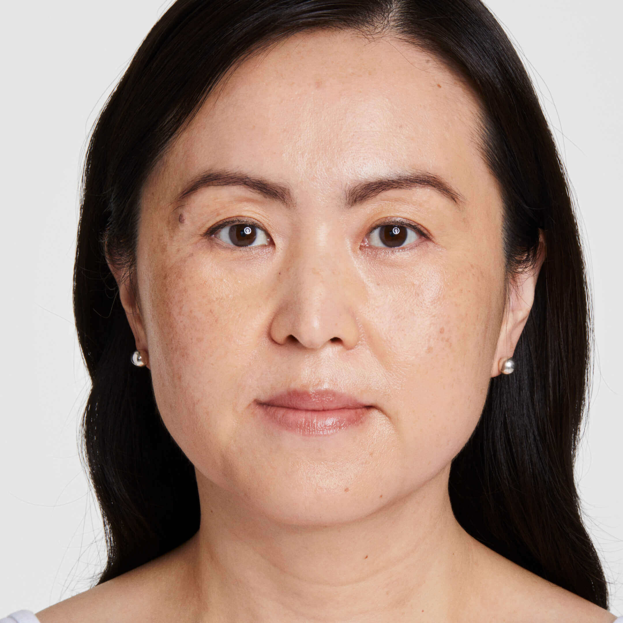 Grace after 60 days of Ultherapy Prime