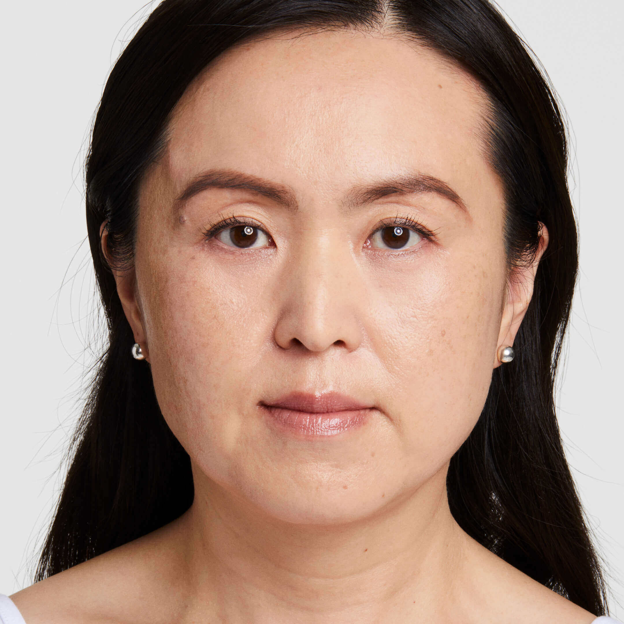 Grace after 90 days of Ultherapy Prime