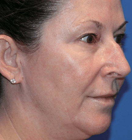 Patient 1 after Density treatment