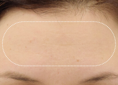 BTL Aesthetics After