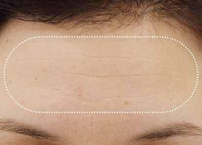 BTL Aesthetics Before
