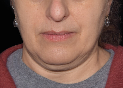 Yael Halaas MD Before