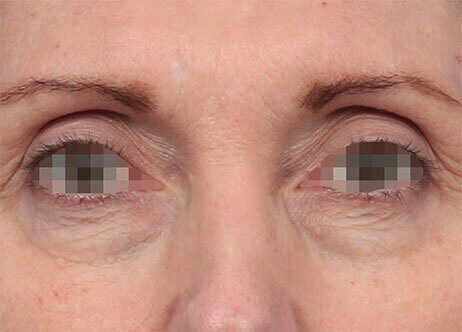 Eyes After 164