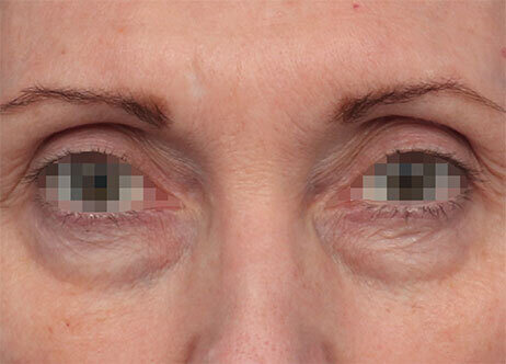 Eyes Before 164
