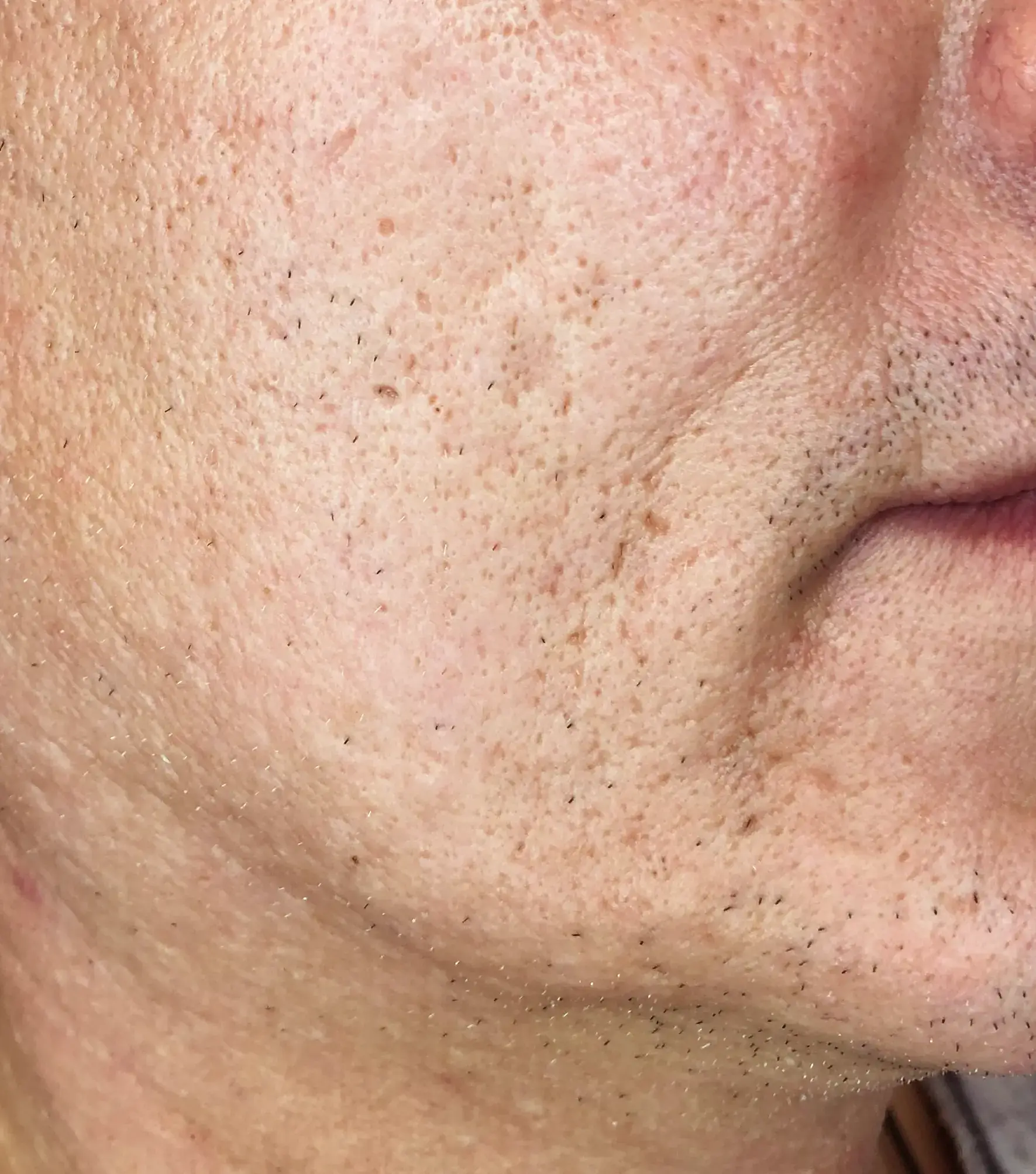 Rafal — After 2T (Left)