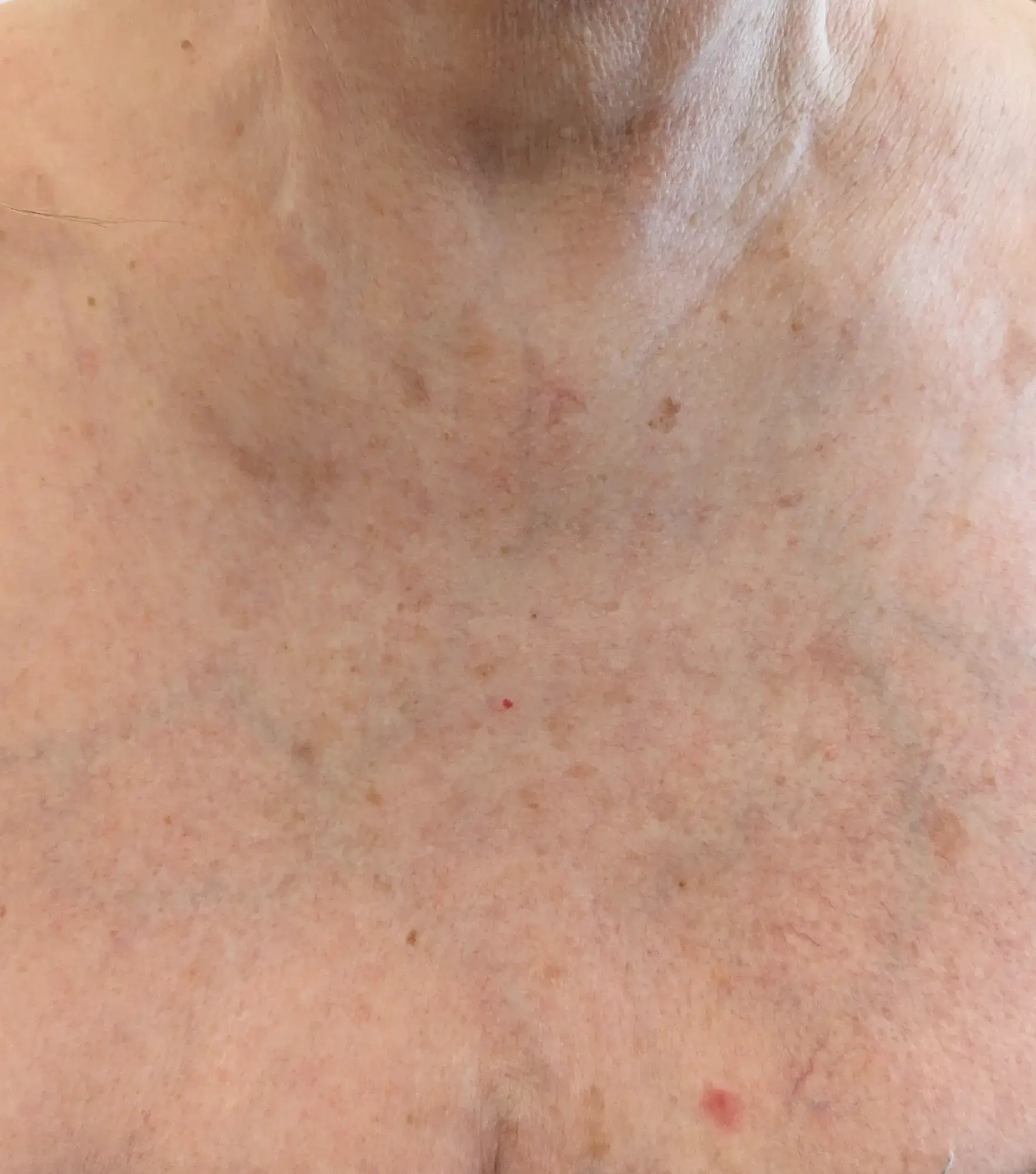 Lesley — After (Front)
