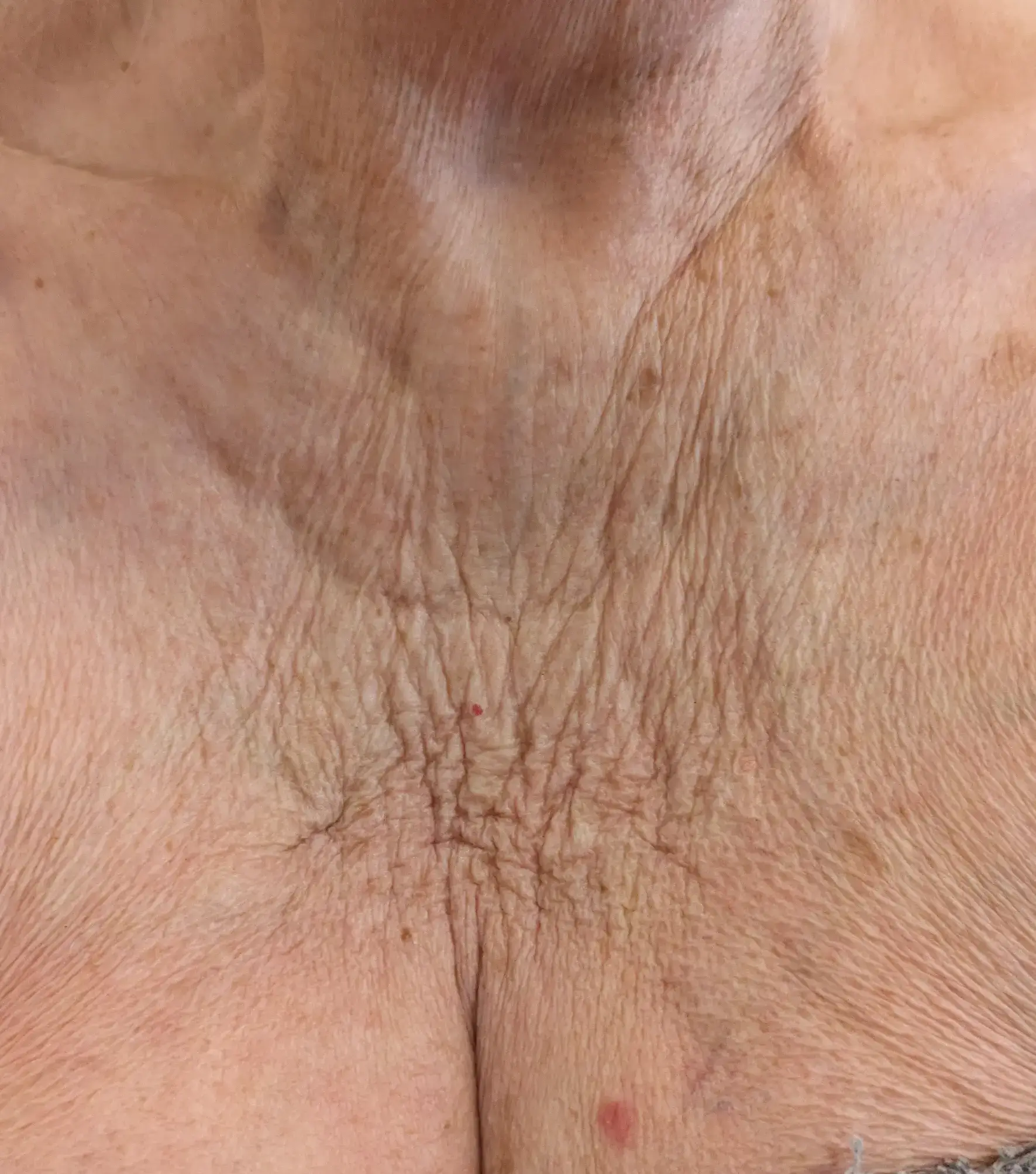 Lesley — Before (Front)