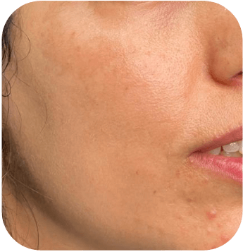 CELLBOOSTER GLOW Case 01 after