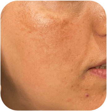 CELLBOOSTER GLOW Case 01 before