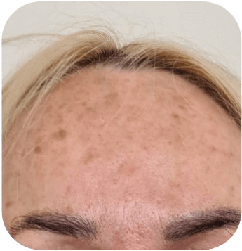 CELLBOOSTER GLOW Case 02 before