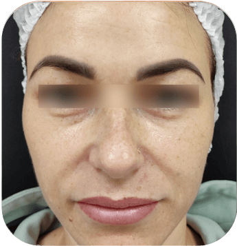 CELLBOOSTER LIFT Case 01 after