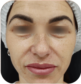 CELLBOOSTER LIFT Case 01 before