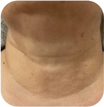 CELLBOOSTER LIFT Case 02 after