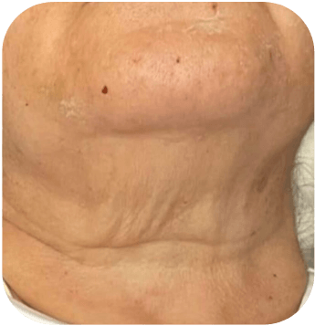 CELLBOOSTER LIFT Case 02 before