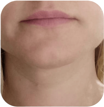 CELLBOOSTER SHAPE Case 01 after