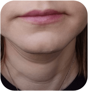 CELLBOOSTER SHAPE Case 01 before