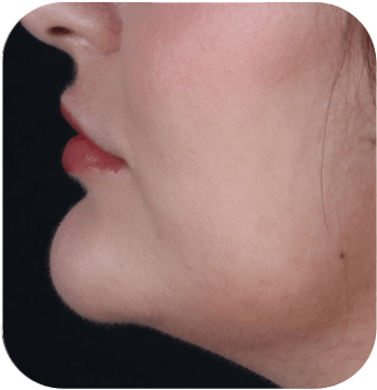 CELLBOOSTER SHAPE Case 02 after