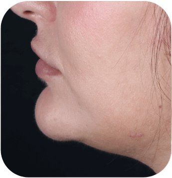 CELLBOOSTER SHAPE Case 02 before