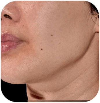 CELLBOOSTER SHAPE Case 03 after