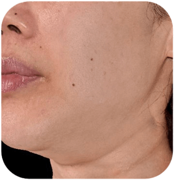 CELLBOOSTER SHAPE Case 03 before