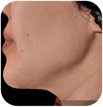 CELLBOOSTER SHAPE Case 04 after