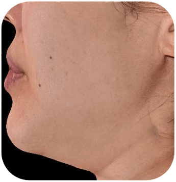 CELLBOOSTER SHAPE Case 04 before